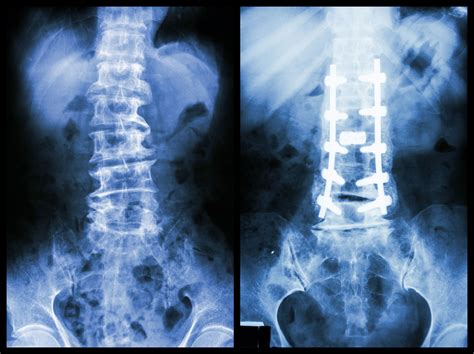 metal brackets pulled from spine|spine hardware breakage.